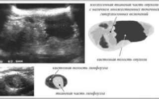 Гипоэхогенный участок в матке: причины и лечение