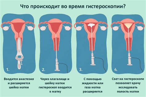 Гистероскопия матки: преимущества и назначение