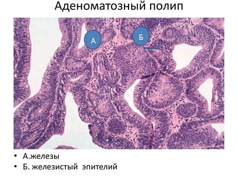 Гистология аденоматозного полипа