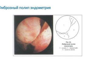 Гистология железисто-фиброзного полипа