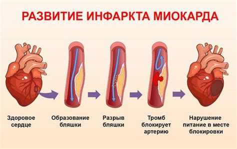 Главные причины дистрофических изменений миокарда