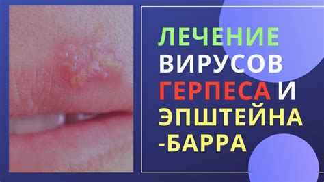 Главные симптомы вируса герпеса