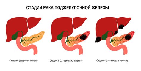 Главные симптомы рака поджелудочной 4 стадии