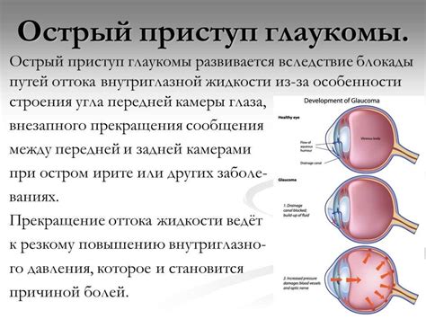 Глазное давление и утомление