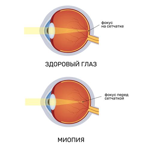 Глазные заболевания