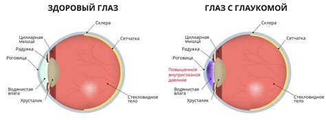 Глаукома глаз: что это такое?