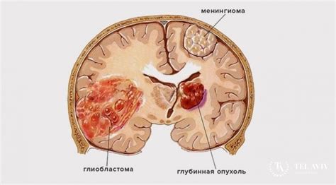 Глиобластома: что это такое и как она возникает?