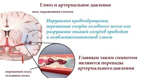 Глиоз и его место в медицинской практике: советы специалиста