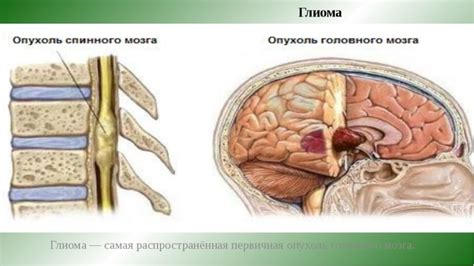 Глиома - что это за раковая опухоль?