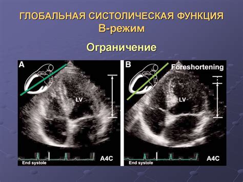 Глобальная систолическая функция левого желудочка