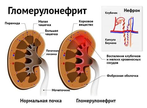 Гломерулонефрит: причины и симптомы