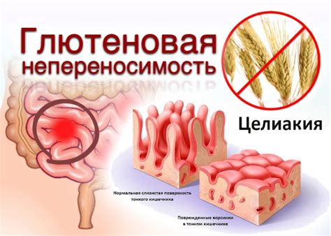 Глютен и целиакия: что нужно понимать?