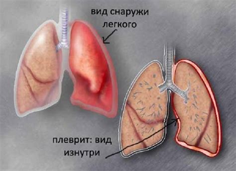 Гнойный плеврит: причины, симптомы и методы лечения