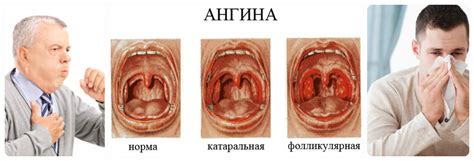 Грудная ангина: понятие и симптомы