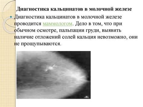 Группа микрокальцинатов в молочной железе