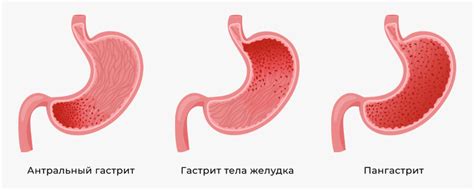 Грыжа антрального отдела желудка