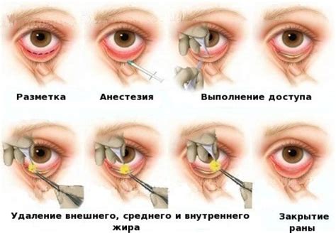 Грыжа верхнего века: базовые понятия