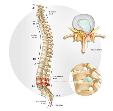 Грыжа в пояснично-крестцовом отделе позвоночника: причины и симптомы