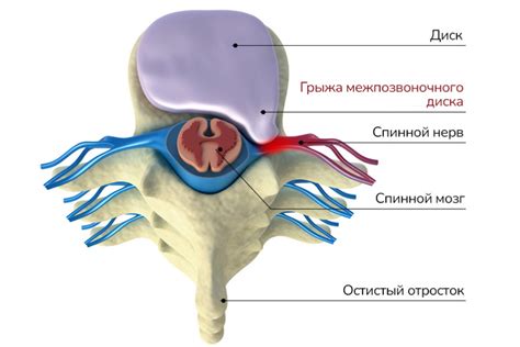 Грыжа на ранфлете и ее возможные причины