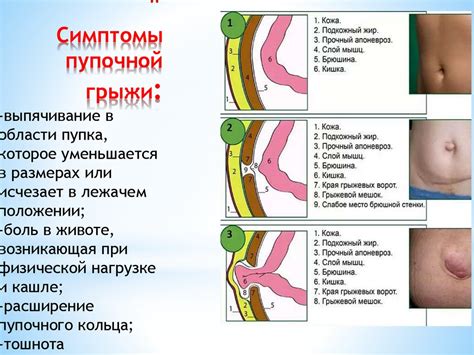 Грыжа пупочная: разучно-опухолевое расширение пупочного кольца