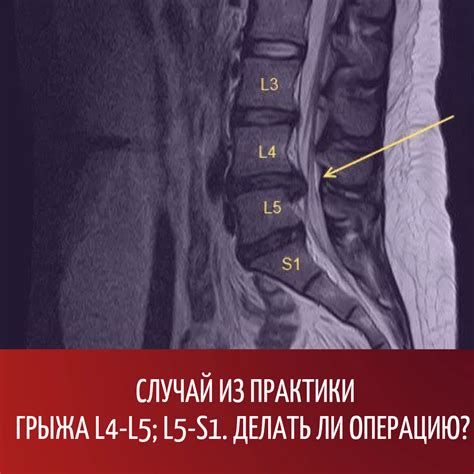 Грыжа со смещением