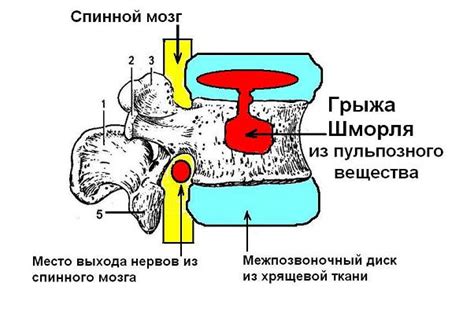 Грыжа шморля th10