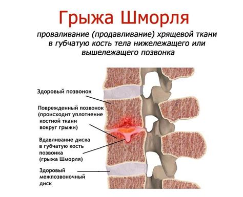 Грыжи шморля: основные симптомы и проявления