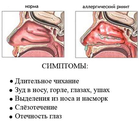 Густые сопли, вызванные аллергией