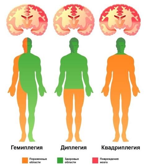 ДЦП (детский церебральный паралич): общая информация