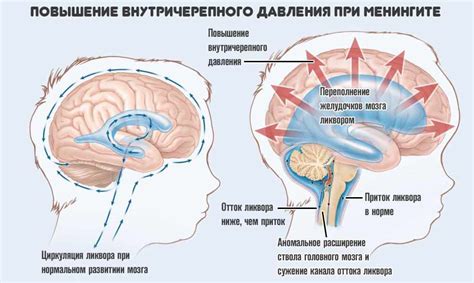 Давление внутри черепа: как оно возникает?