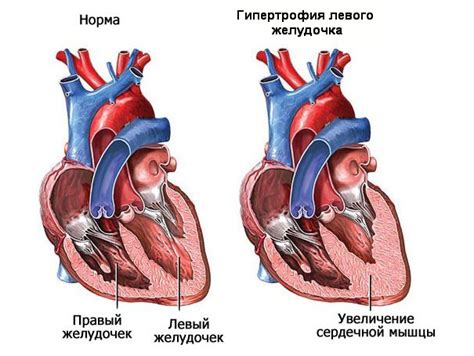 Диагностика атрофии левого желудочка сердца