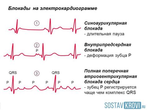 Диагностика блокады сердца и методы обнаружения