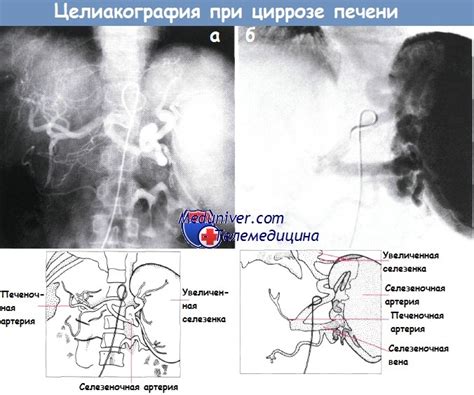 Диагностика гепаторенального синдрома