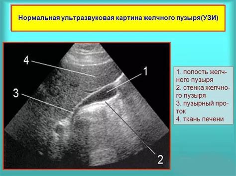 Диагностика гипотонического желчного пузыря