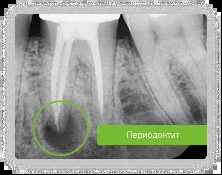 Диагностика гноится корня зуба