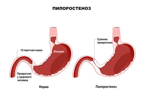 Диагностика деформации привратника желудка