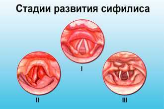 Диагностика зева гиперемированного