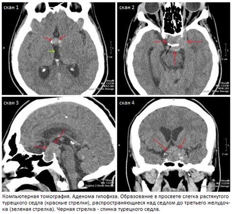 Диагностика изменения структуры гипофиза