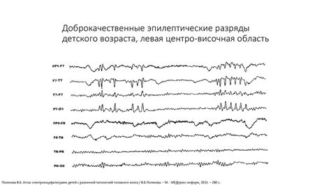 Диагностика и лечение ЭЭГ десинхронизованного типа