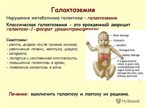 Диагностика и лечение галактоземии