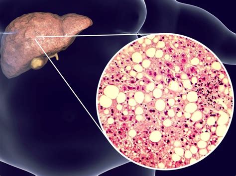 Диагностика и лечение жировой инфильтрации печени
