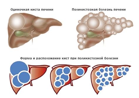 Диагностика и лечение кисты печени у мужчин