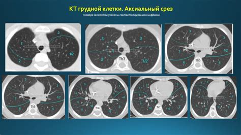 Диагностика и лечение немногочисленных очагов в легких на КТ