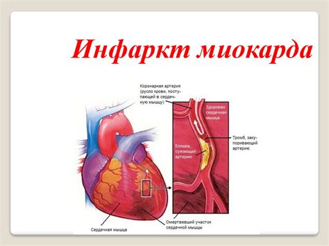 Диагностика и лечение обменных нарушений миокарда