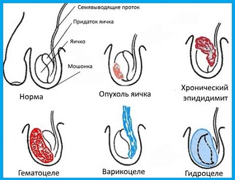 Диагностика и лечение опухшей мошонки