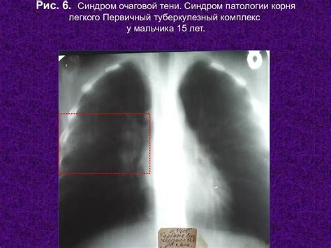 Диагностика и лечение очаговой тени левого легкого