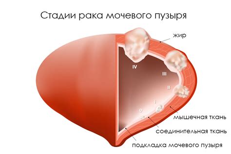 Диагностика и лечение патологического отслоения мочевого пузыря