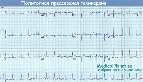 Диагностика и лечение предсердной тахикардии