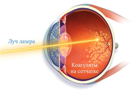 Диагностика и лечение ретиношизиса сетчатки глаза