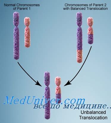 Диагностика и лечение транслокации хромосом